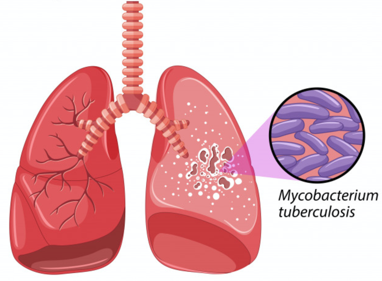 En conmemoraci n del d a mundial de la tuberculosis